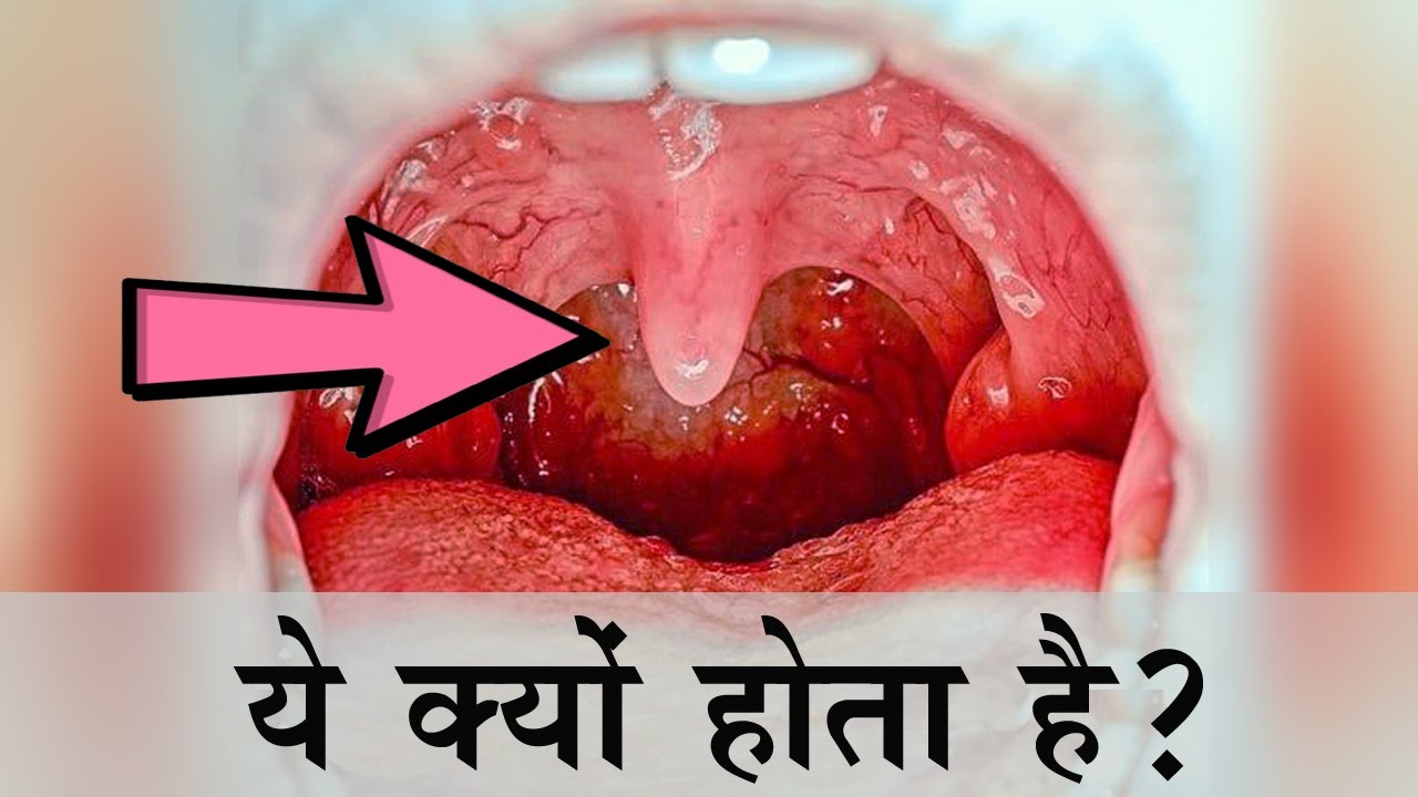  Uvula Function In Hindi What Is Uvula 