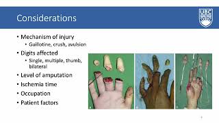 An Approach to the Management of an Amputated Digit