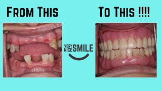 A case of an Immediate upper denture and a lower cusil partial denture