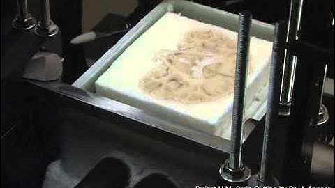 Brain slices of famous patient create 3D model