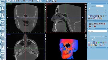 Creating a pseudo panoramic view of 3D volume in Planmeca Romexis®