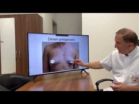 Augmentare mamară cu implante Mentor anatomice 330CC