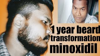 how to grow beard Mintop 5% minoxidil topical solution 1 beard transformation