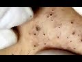 Amazing Blackheads... just wait for it