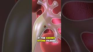 Kidney Stone Passing - Observation  #healthandwellness