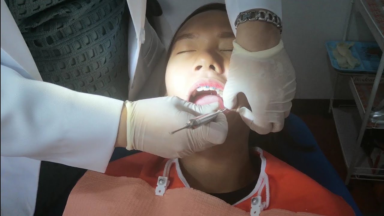 BRACES ADJUSTMENT FULL PROCEDURE // Part 2 My Braces Journey Geriza Rico YouTube