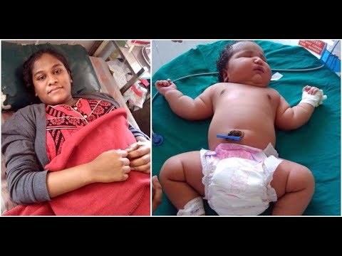le-médecin-qui-a-assisté-à-la-césarienne-n'avait-jamais-vu-un-bébé-comme-ça