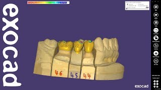 exocad Quick Guide: New features in DentalCAD 2.2 Valletta screenshot 4