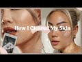 How I Cleared My Skin | acne & acne scars, skincare tips, lifestyle changes, self care tips