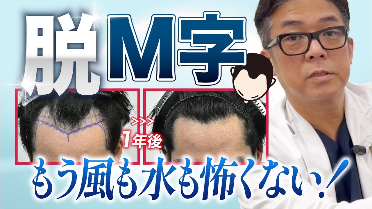 You'll regret not knowing this! M-shaped hairlines can be filled