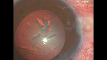 Dr Little technique to rescue a run-out capsulorhexis