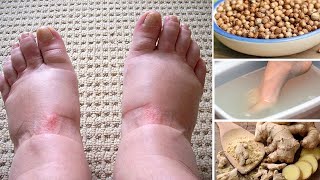 Home Remedies for Swollen Feet during Pregnancy