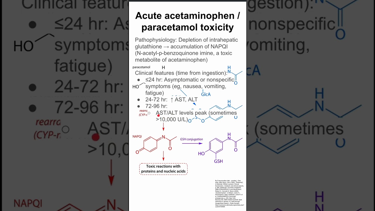 Acute acetaminophen / paracetamol toxicity