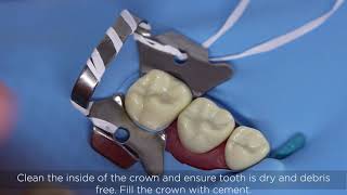 Stainless steel crown placement