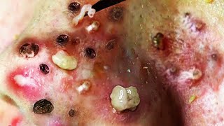 Treatment Satisfying blackhead relaxing  acne, pimple, cyst by FISHING VIDEO 115 views 1 year ago 5 minutes, 15 seconds