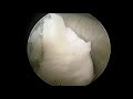 Transforaminal Endoscopic L1L2 discectomy