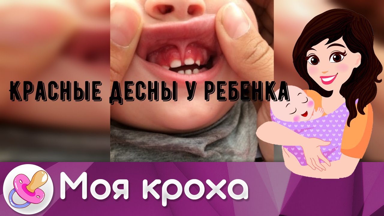 Красные десны у ребенка