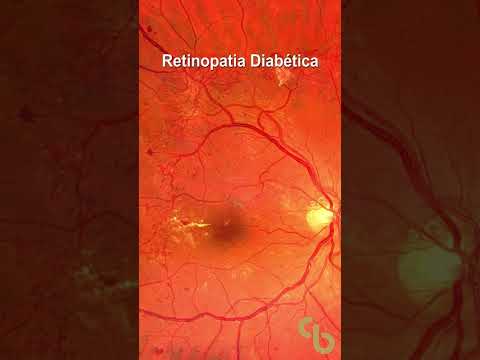 Vídeo: Como tratar a retinopatia diabética: 8 etapas (com fotos)