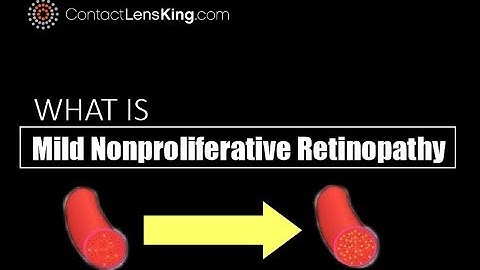 Mild Nonproliferative Retinopathy