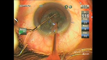 Divide and Conquer Phacoemulsification for soft cataract by Sugato Paul