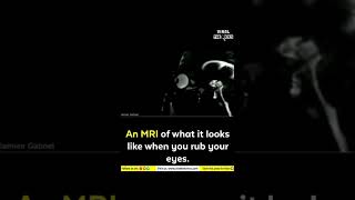 AN MRI OF WHAT IT LOOKS LIKE WHEN YOU RUB YOUR EYES #SHORTS #1