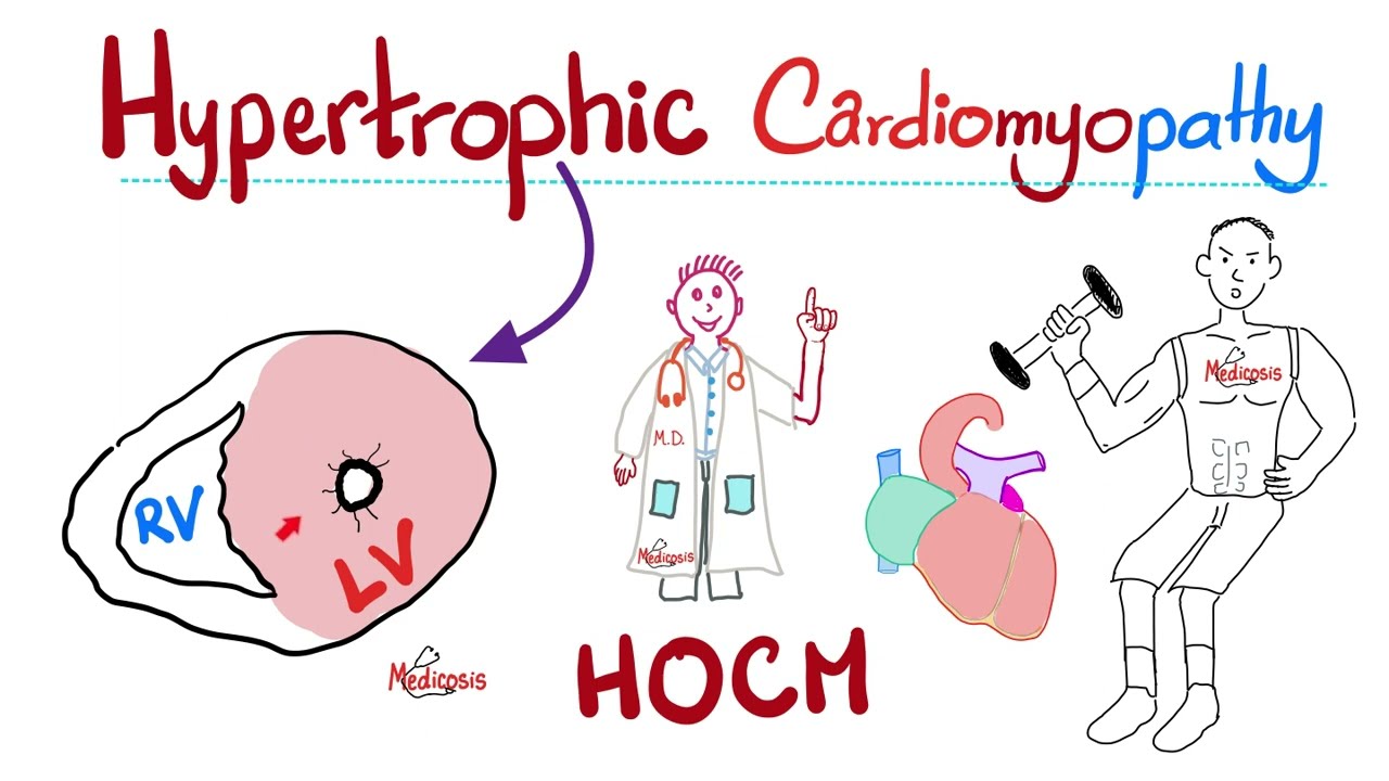 Hypertrophic Cardiomyopathy (HOCM) - Sudden Cardiac Death - Cardiology Series