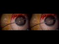 3D 手术治疗：皮质性白内障的晶状体抽吸术