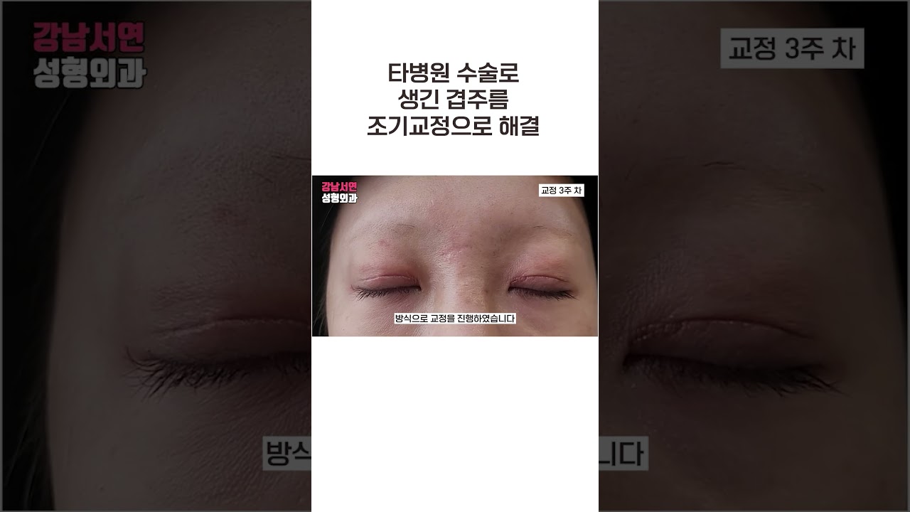 [Ганнам Соён Гоо Сайхны Мэс Заслын Эмнэлэг] Өөр эмнэлэгт хийсэн мэс заслын улмаас үүссэн давхар үрчлээсийг эрт засвараар амжилттай шийдвэрлэлээ.