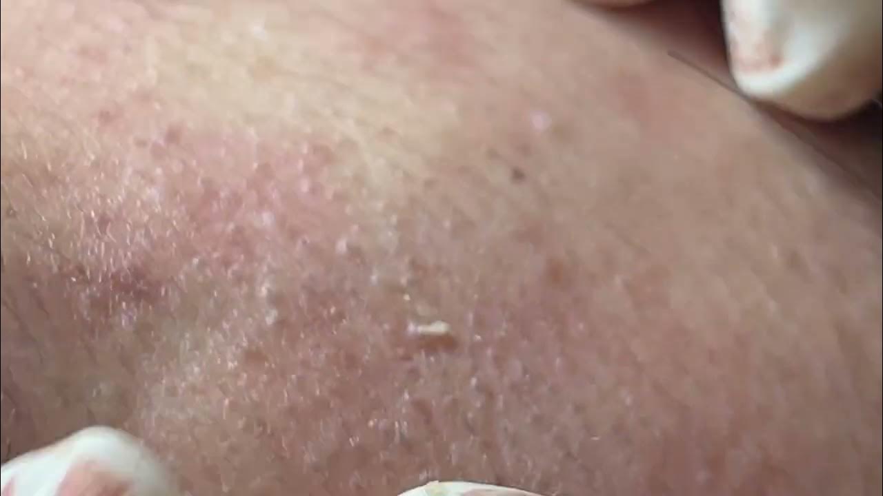 ACNE TREATMENT MAI NGOC - Mai Ngoc’s Family - YouTube