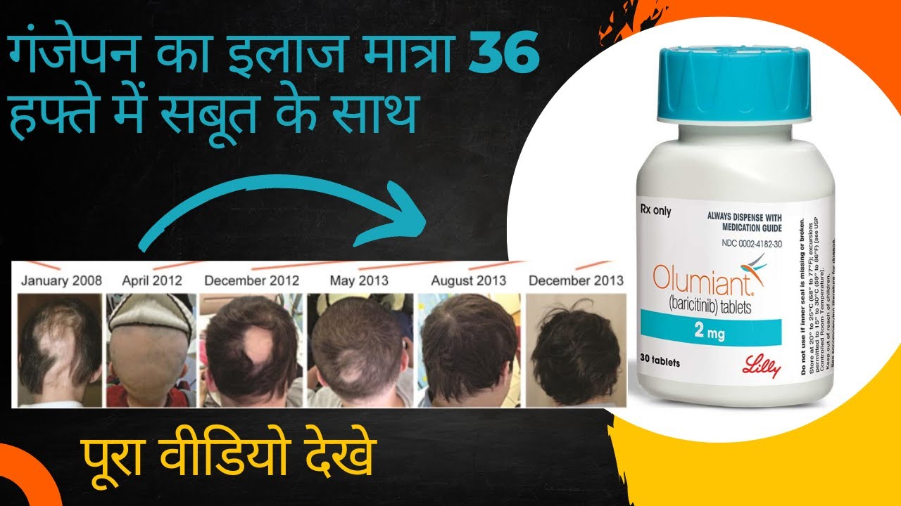 medicine-for-alopecia-baricitinib-olumiant-4mg-tablets