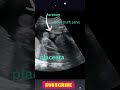 Ultrasound Showing Baby Boy 👶 | Gender Reveal #shorts