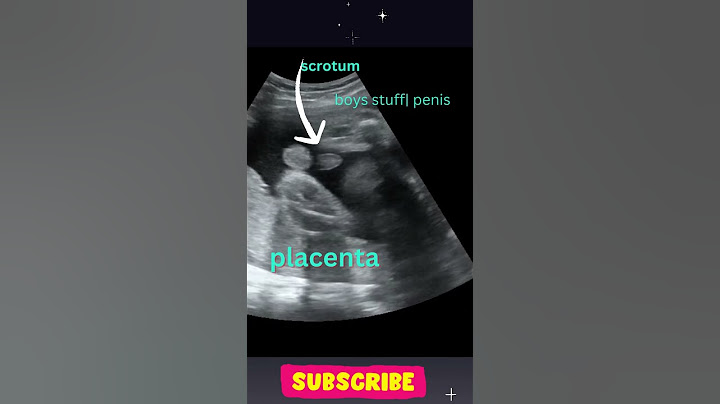 Ultrasound Showing Baby Boy 👶 | Gender Reveal #shorts