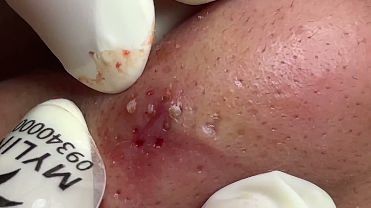 RIESENKOMEDO in der Leiste entfernt: Hautarzt kann es kaum fassen. Mitesser  #pimple giant comedone
