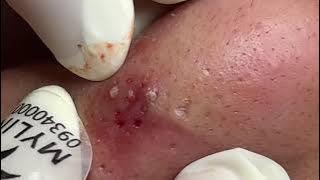 Very Rare Blackheads Flower Pattern 😅 - Linh My Dang