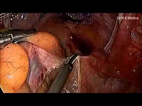 Master Class on Sacrohysteropexy by Dr.R.K.Mishra