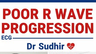Poor R wave progression in ECG | one watch to remember the causes forever 