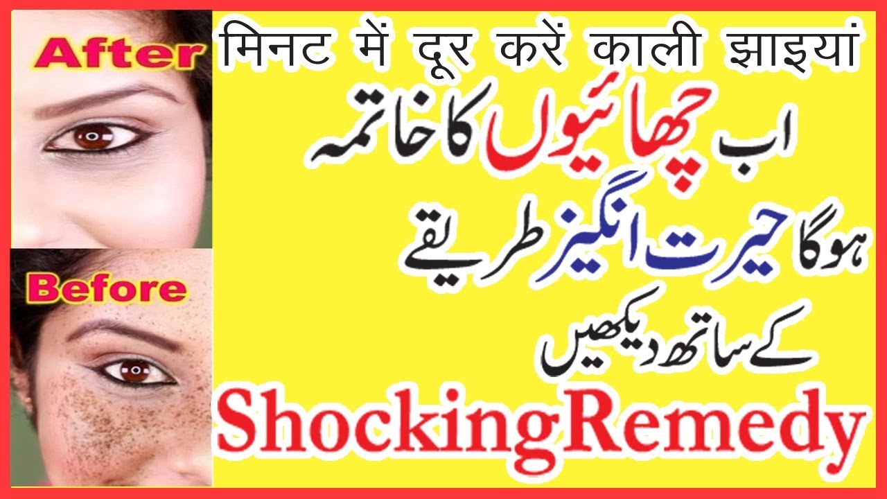 Amazing Freckle Removal Cream | How To Get Rid Of Freckles On Face Permanently | By Sanam video editing software free