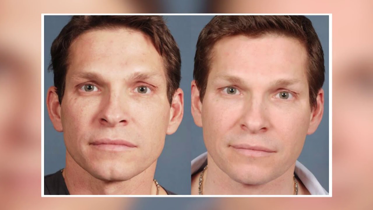 Dr. Calobrace - Botox, Fillers, or Both?