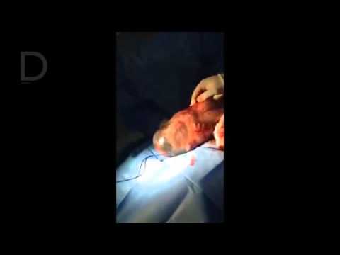 Video: Un bambino può nascere con il sacco amniotico intatto?