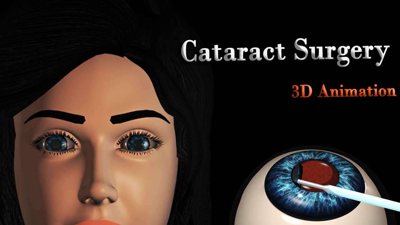 Катаракта и хирургия катаракты (3D-анимация)
