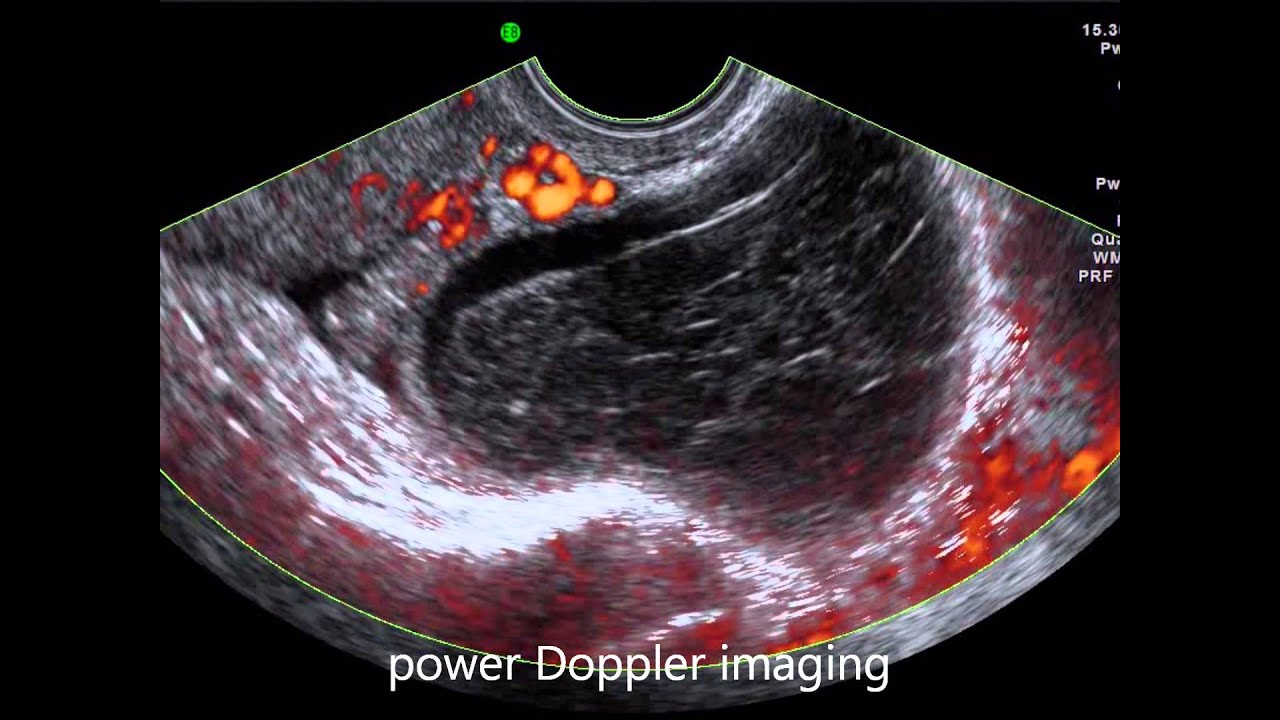 Ovarian Cyst CT Scan