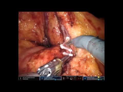 Complete Robotic Mesocolic Excision For Right-sided Colon Cancer- Cleveland Clinic Approach