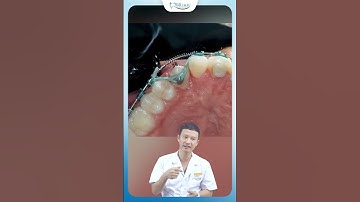 Kéo Răng Mọc Ngầm Hàm Dưới Khi Niềng Răng | Bác Sĩ Yên