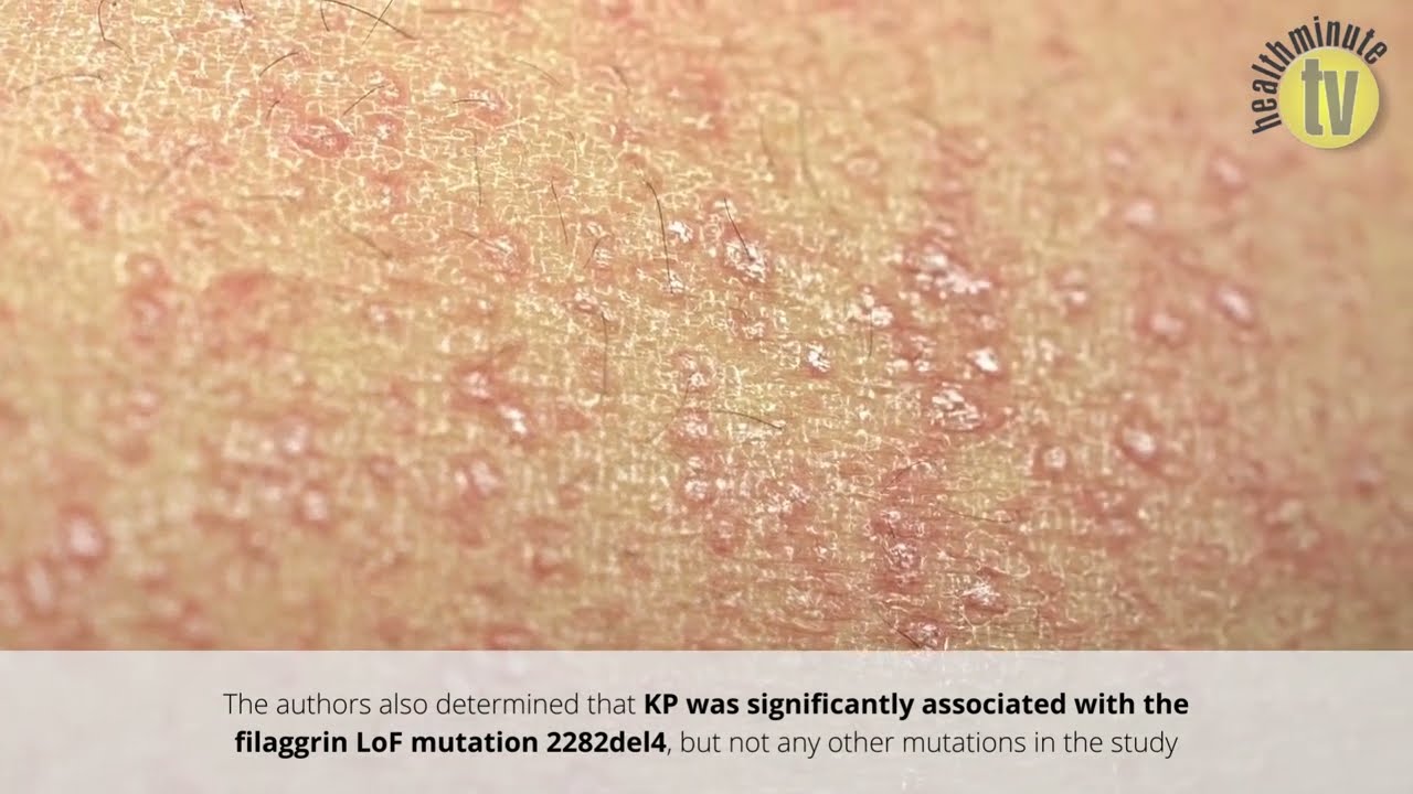 VIDEO: Study suggests prevalence of keratosis pilaris is low in AD patients