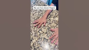 Thumbnail of MY SON HAS 11 FINGERS!!