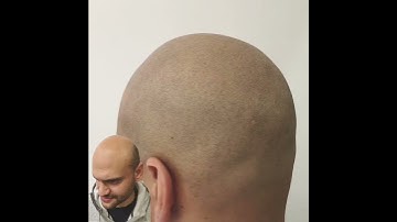 the Art of Scalp-Micropigmentation True Life