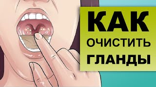 Как Выглядят Гланды Фото