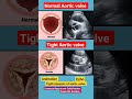 Normal and Tight Aortic valve l  l Animation #echo #shorts