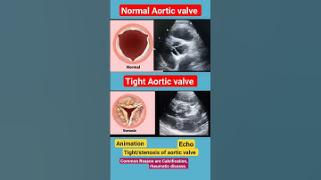 Normal and Tight Aortic valve l  l Animation #echo #shorts