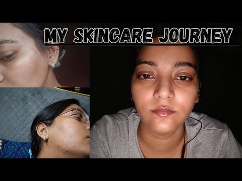 MY ACNE PRONE SKIN JOURNEY | HOW I TREAT MY ACNE PRONE SKIN | ACNE TO ...